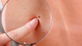 Ранни симптоми на рак на кожата