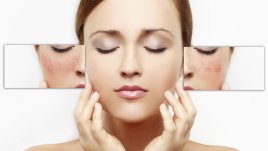 Естествени методи за борба с комедоните