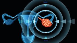 Каква е ролята на наследствеността при рака на яйчниците?