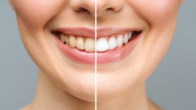 Как да избелим зъбите си у дома?