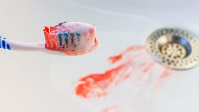 Топ 5 причини за кървящи венци 