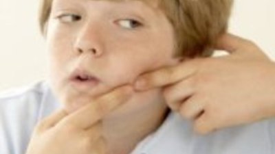 Акне &ndash; бич за тийнейджъри и не само