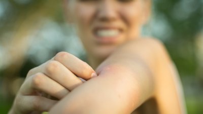 Етерични масла, успокояващи ухапване от насекоми 