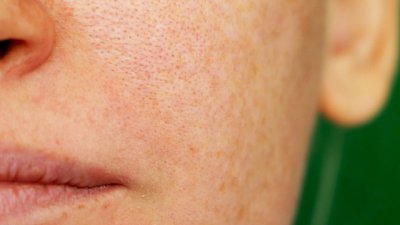 Как да се справим с пигментните петна по кожата?