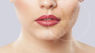 Храни, борещи се с акнето и черните точки