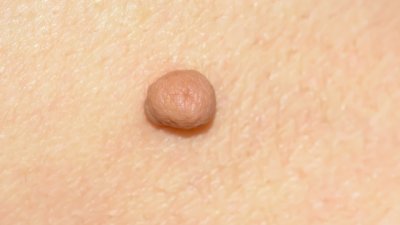 Лесен начин за премахване на папиломи