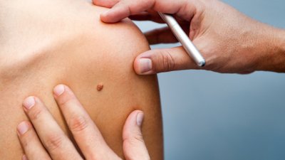 Проверете бенките си – дерматолози преглеждат безплатно във ВМА