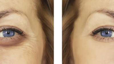 Какви са причините за подпухнали клепачи? 