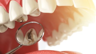 Трикове за предпазване от кариес