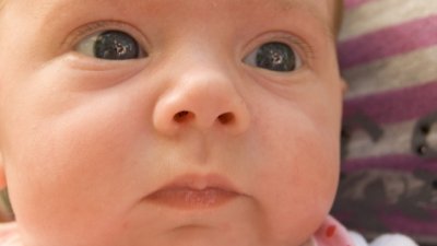 Хемангиом при децата – решенията