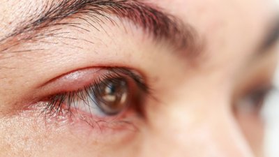 Домашни лекове при ечемик на окото