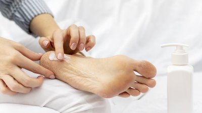 Урея в козметиката за крака &ndash; при напукани пети и мазоли
