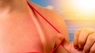 Вълшебни природни методи против изгаряния 