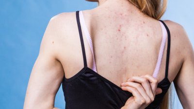 Ефективни природни методи срещу акне по гърба  