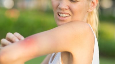 8 начина да намалите сърбежа при ухапване от комар