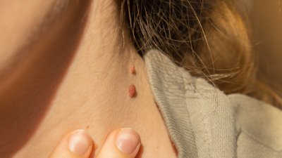 Натурални начини за премахване на папиломи по кожата