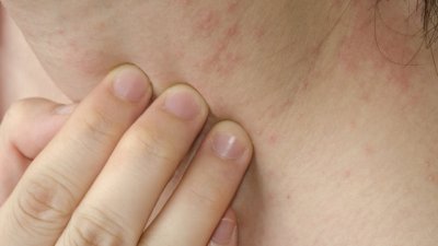 Що е то студова алергия?