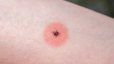 5 съвета, които ни пазят от кърлежи