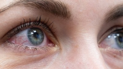 Какво предизвиква зачервяване на очите