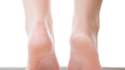 Витамини и минерали при напукани пети