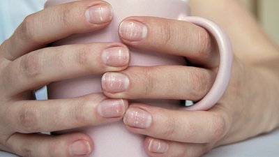 Какво означава, ако имате ивици по ноктите?