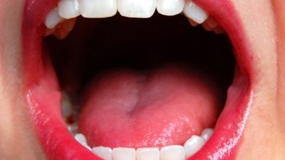 За какво подсказват белите петна по езика?