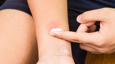 Състояния, които често се бъркат с алергия 