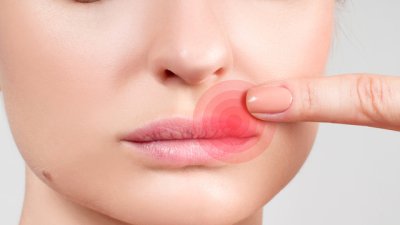 Натурални лекове при херпес