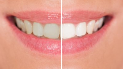 Неочаквани причини зъбите ви да се оцветят