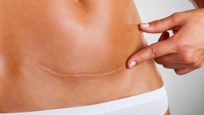 Как да заличим неприятните белези