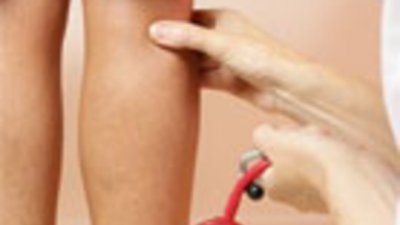 Дни за борба с разширените вени