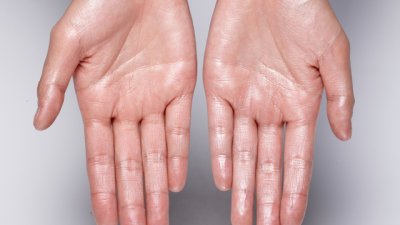 Какво означава, ако дланите ви са постоянно изпотени? 