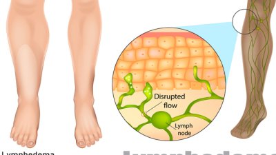 Безплатни прегледи за лимфедеми във ВМА