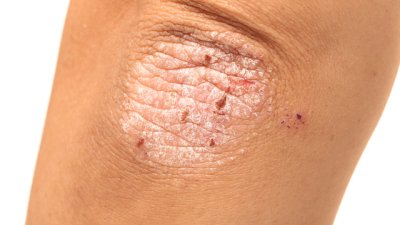 5 от най-добрите храни при псориазис 