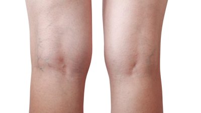 Природни средства за облекчаване на разширени вени
