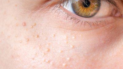 Натурални грижи за премахване на милиуми по кожата