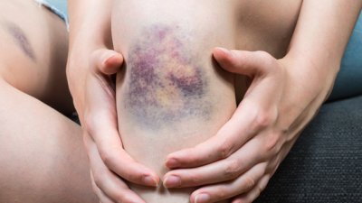 8 причини за необясними синини по тялото 