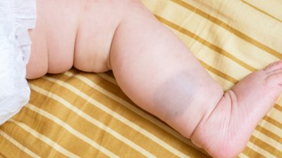 Видовете белези и петна по рождение