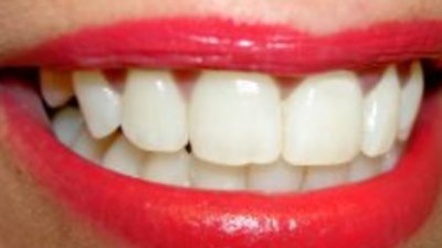 Какво представлява избелването на зъби? Видове избелвания