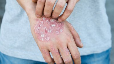 Болести, които мислите за заразни, но не са 