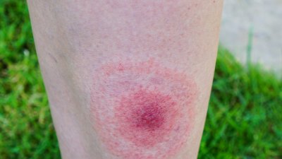 Безплатни прегледи във ВМА за лаймска болест