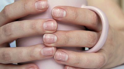 Признаци на бъбречни проблеми, които ноктите издават 