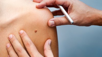 Симптоми на рак на кожата, различни от нова бенка 