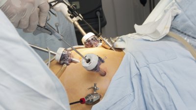 Всичко за бариатричните операции