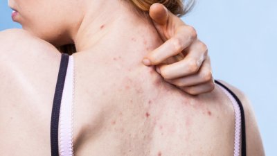 Какво причинява акне по гърба? 