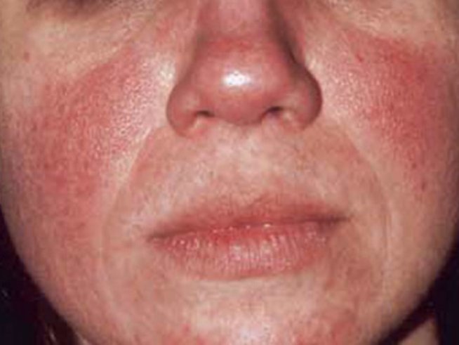 Снимка: rosacea.org