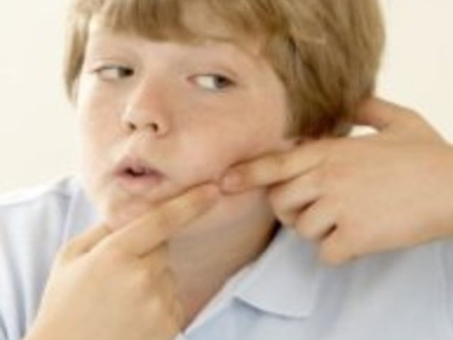 Акне – бич за тийнейджъри и не само