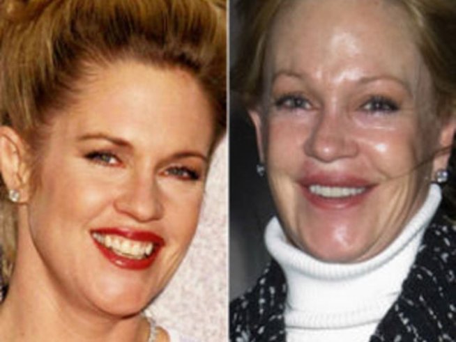 Най-несполучливите пластични операции на известни личности