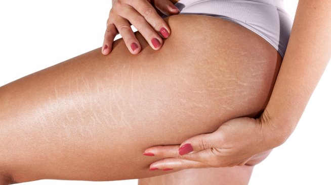 Домашен лосион против стрии с кокосово масло. Снимка: istock