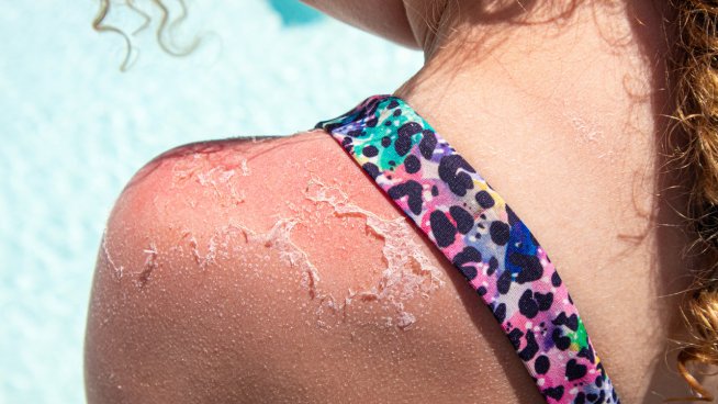 Незабавни трикове за успокояване на изгоряла кожа. Снимка: istock